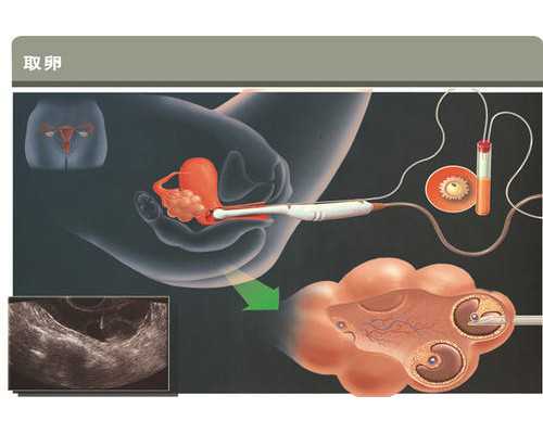 上海医院代孕,2024年在上海三代试管婴儿生男女的过程和所耗时间是怎么样的？